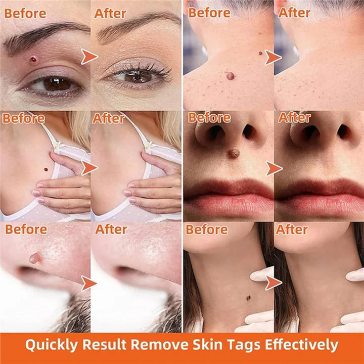 Skin Tag Removal Kit with Dual Spring Applicators and Blood Flow Restriction