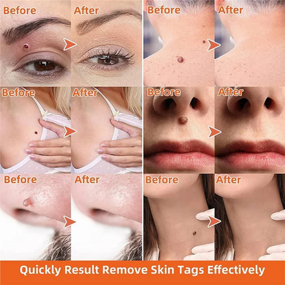 Skin Tag Removal Kit with Dual Spring Applicators and Blood Flow Restriction