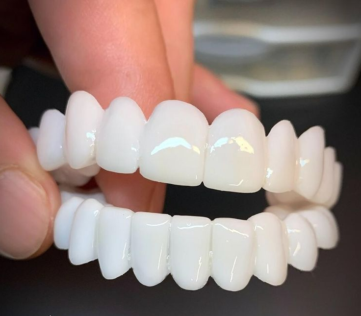 Removable Dental Veneers with Custom Moldable Fit and Natural Look Coverage, Reusable