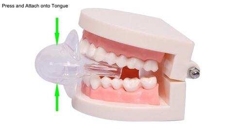 Apnea Tongue Stabilizing Device