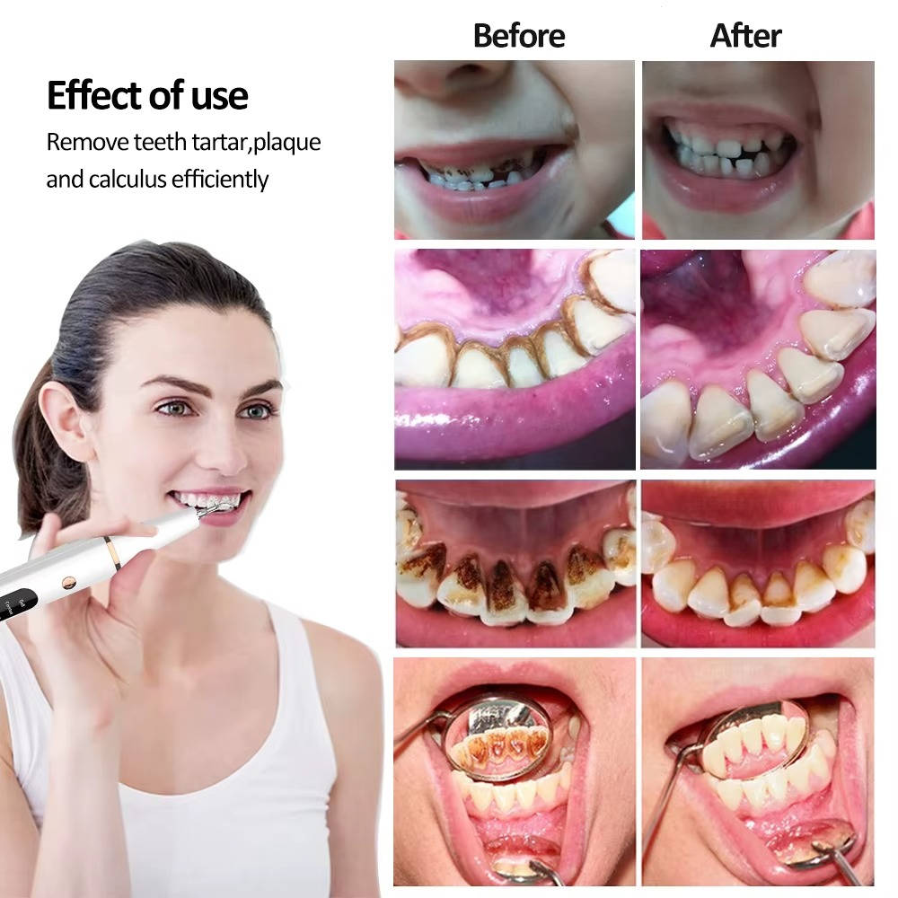 Electric Dental Teeth Calculus & Tartar Remover Kit, 5 Adjustable Modes with Led Light