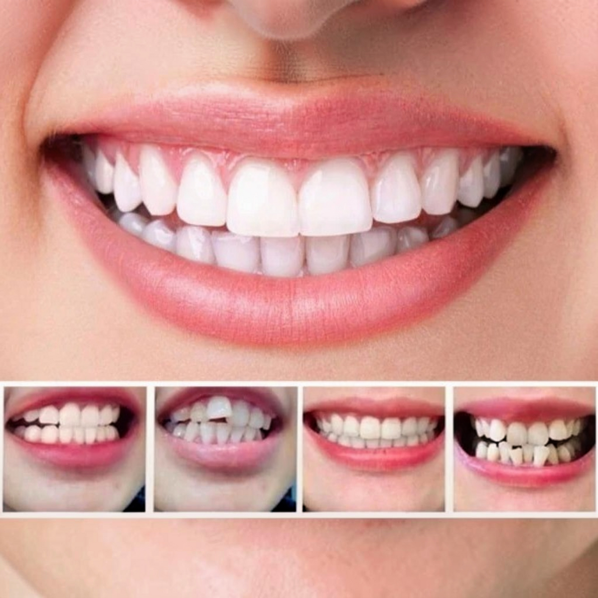 Invisible Dental Realignment Tray