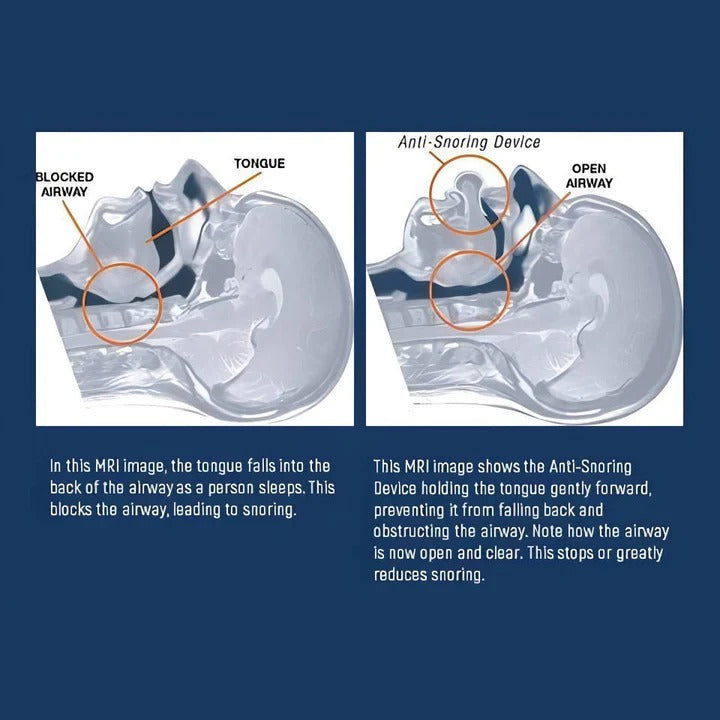 Silicone Tongue Positioning Device for Nighttime Comfort