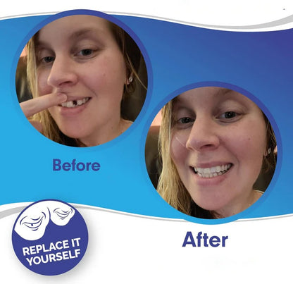 Removable Smile Veneers for Upper and Lower Teeth
