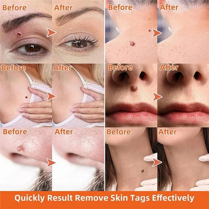 Automatic Skin Tag Remover for Home and Personal Use