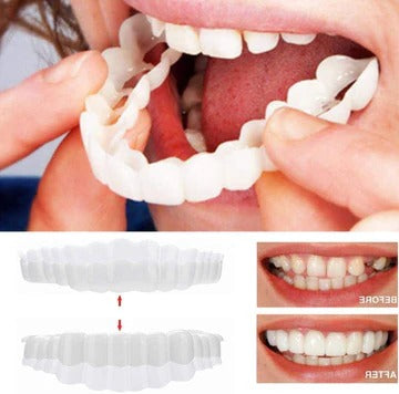Smile Veneer (Upper & Lower Included)