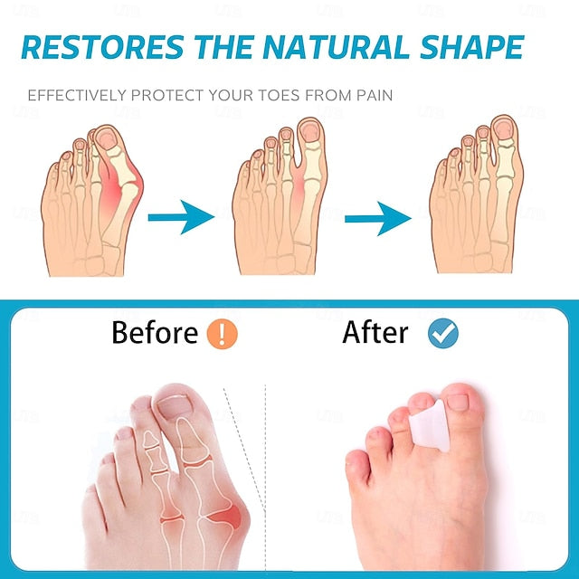 6 Pack Hammer Toe Corrector Splint with Toe Spacers for Bunions and Curled Toes in Men and Women